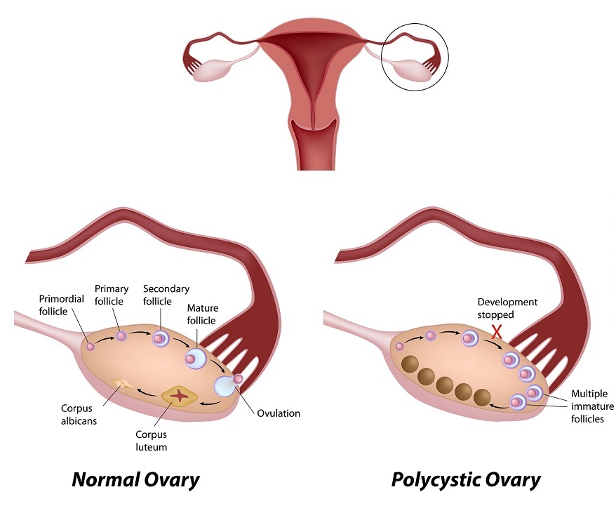 pcos