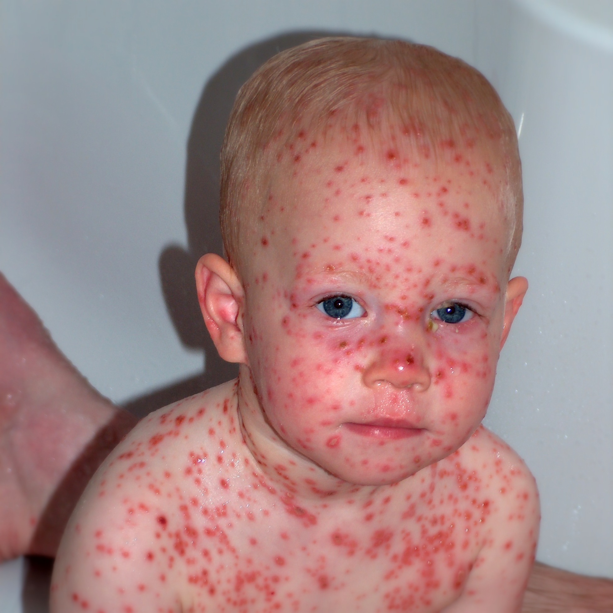 chicken pox 