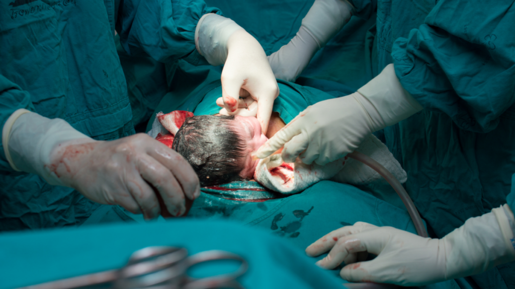 bersalin secara cesarean