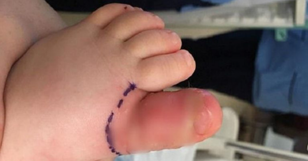 necrosis ibu jari kaki