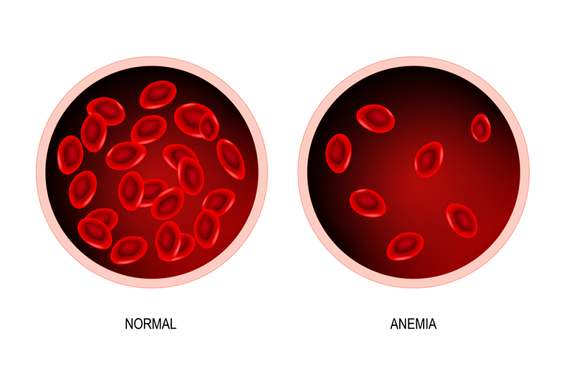 anemia ketika hamil 