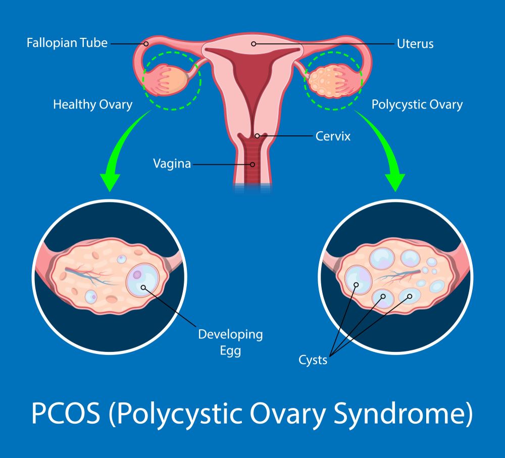 Apa yang mama perlu tahu dengan Sindrom Ovari Polisistik (PCOS)