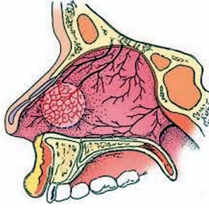 Hidung Berdarah? Ini Cara Hentikan Pendarahan