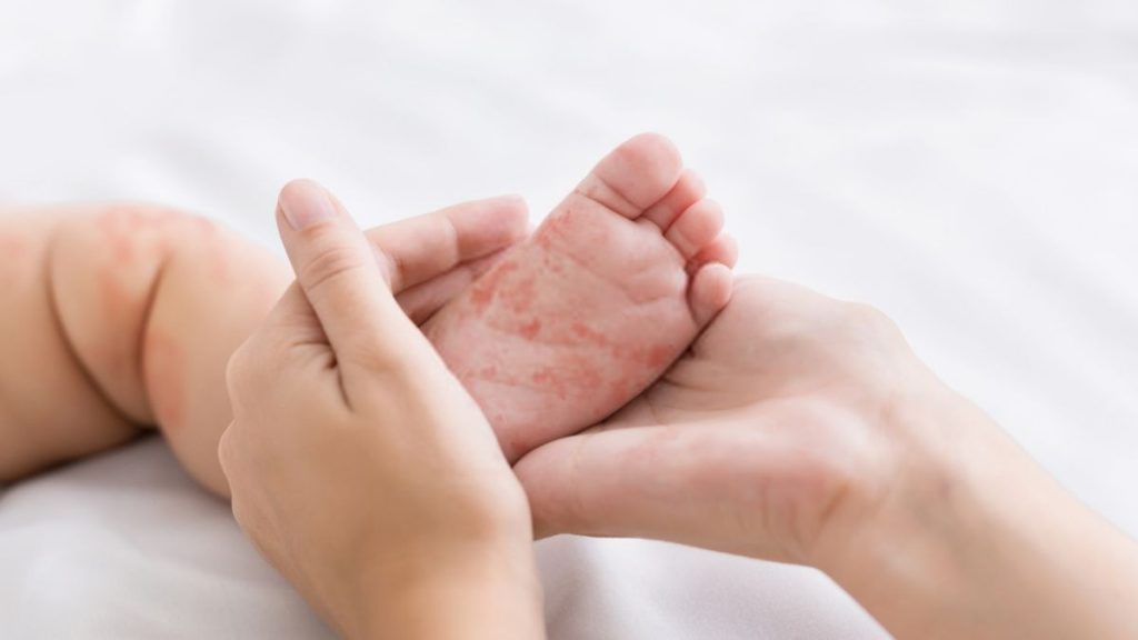 Virus Measles Buat Badan 'Lupa' Cara Lawan Penyakit