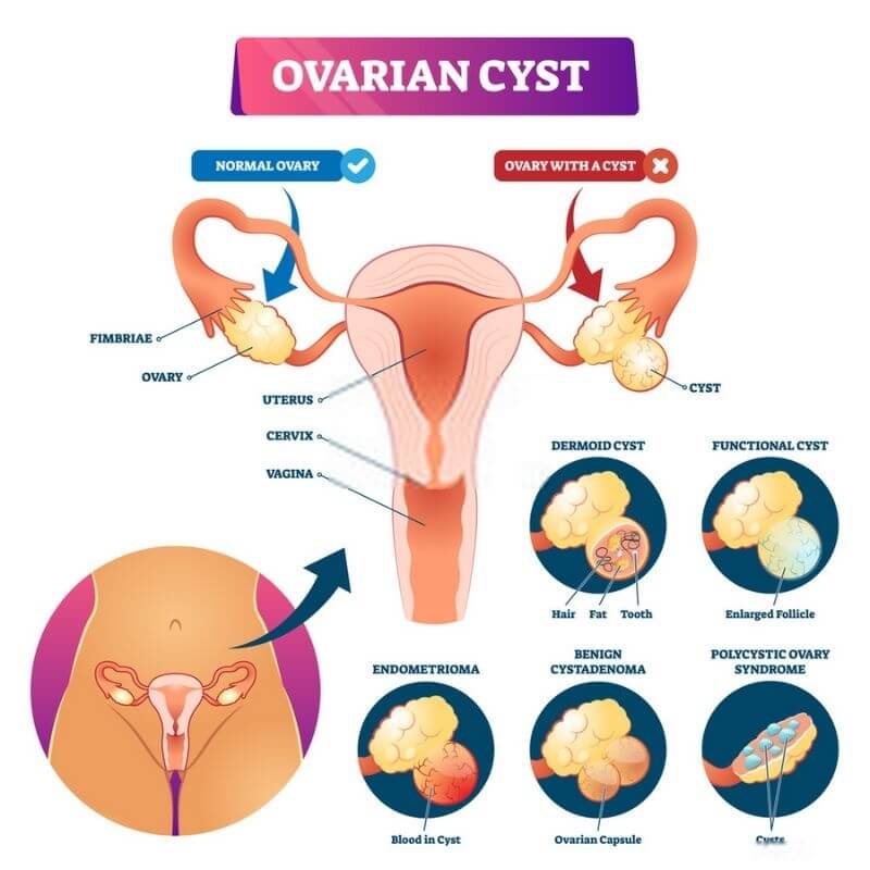 Ovarian Cyst Takkan Sembuh Dengan Suplemen, Jangan Tertipu!