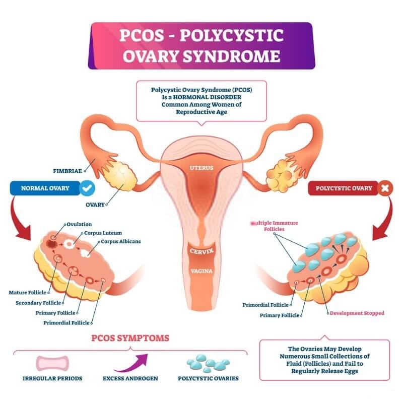 Ovarian Cyst Takkan Sembuh Dengan Suplemen, Jangan Tertipu!