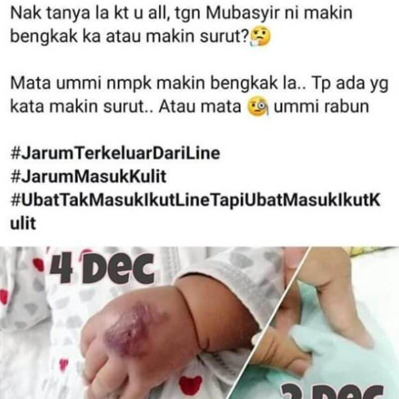 Tangan Bayi Bengkak Teruk Akibat Jarum Terkeluar Dari Line