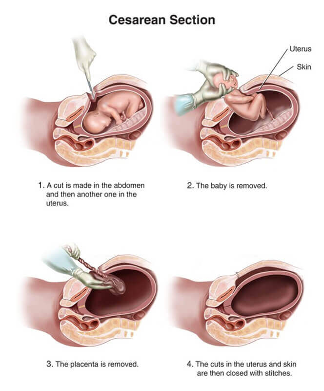 bersalin c-section