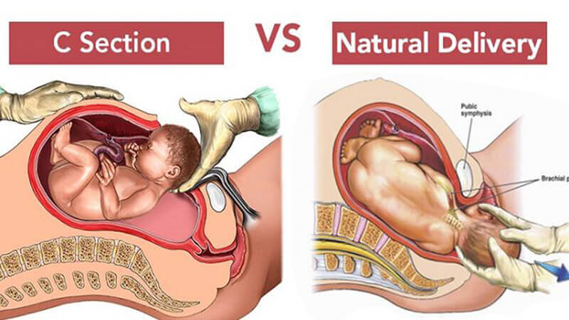 bersalin normal vs c-section
