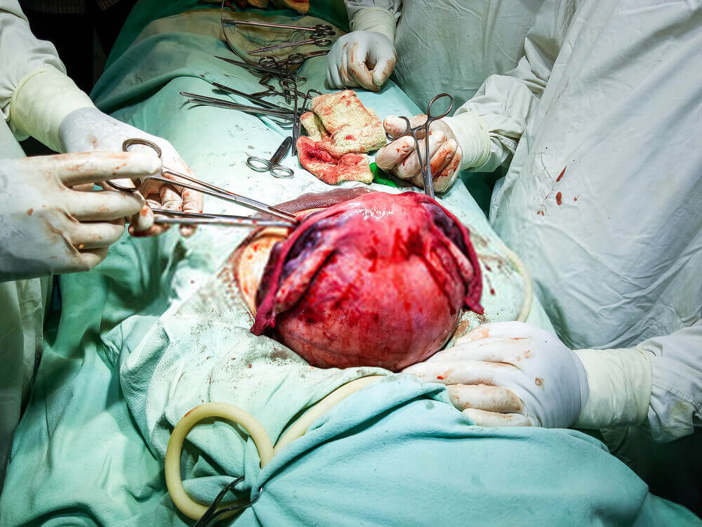 Cyst operation