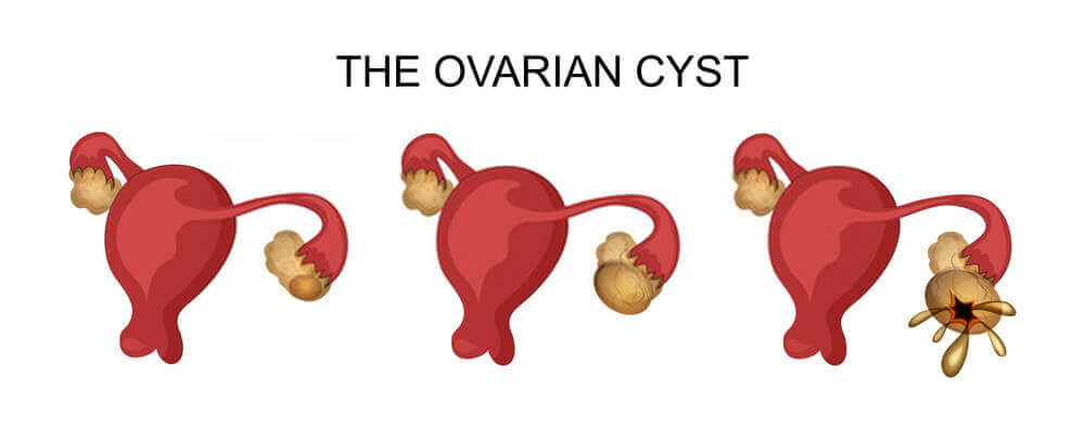 ovarian cyst