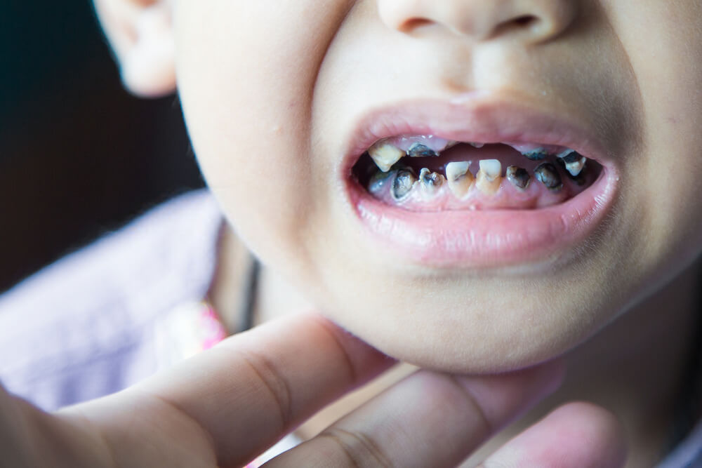 gigi mudah rosak antara kesan buruk minum kopi pada kanak-kanak