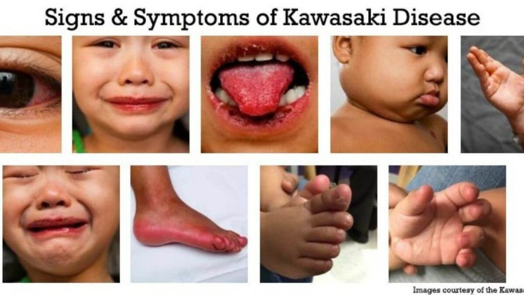 simptom penyakit kawasaki