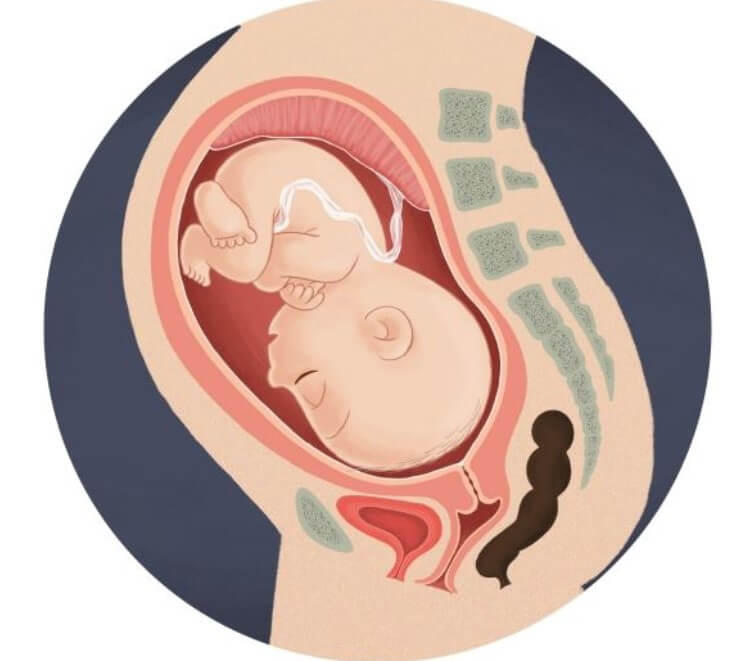 kedudukan bayi dalam kandungan - posterior
