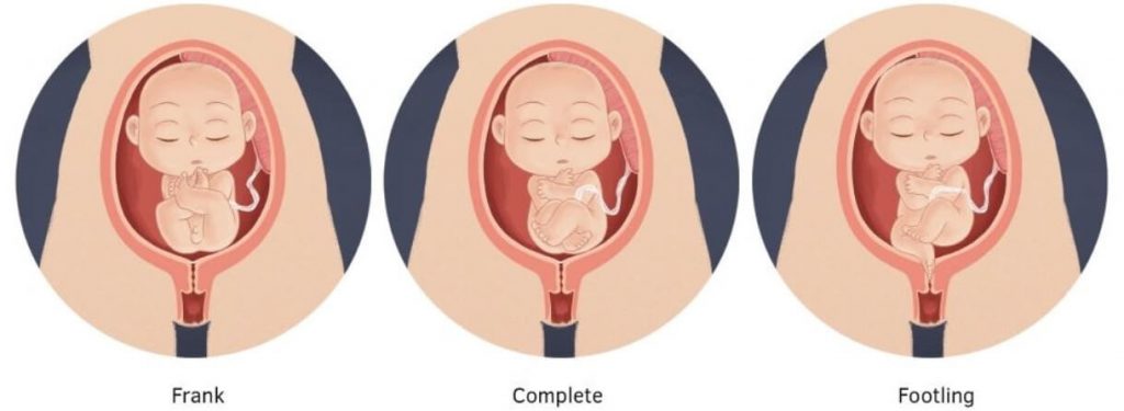 kedudukan bayi dalam kandungan - songsang