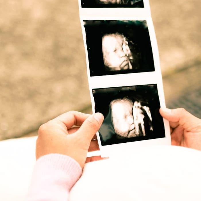 ultrasound anak rahim