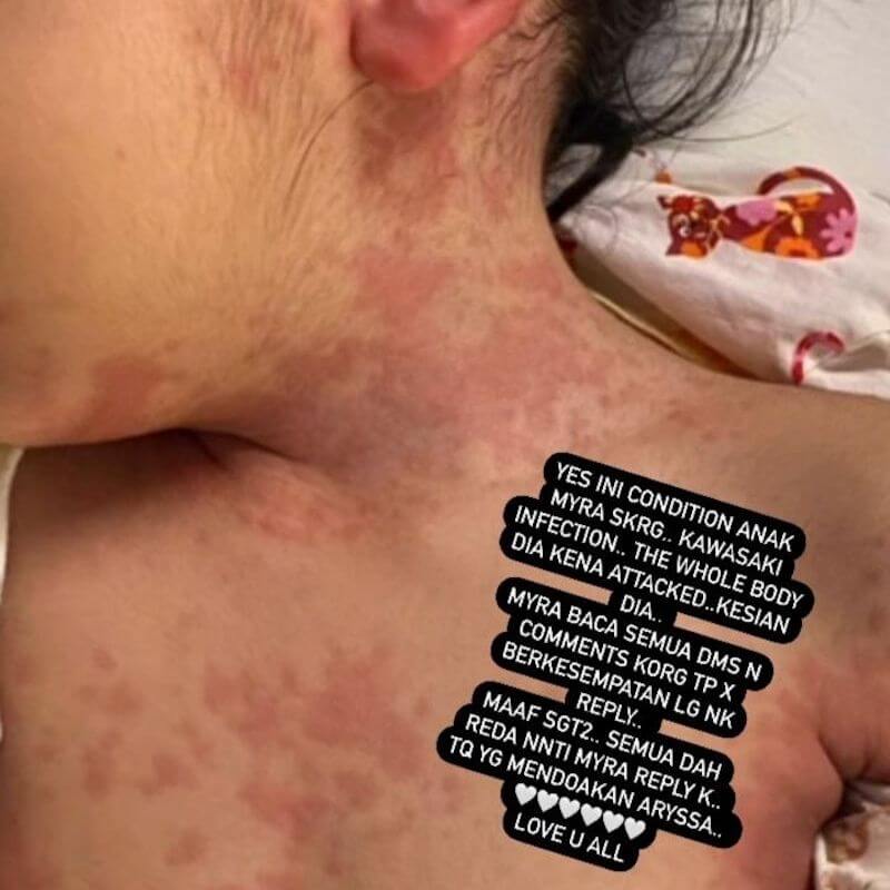 anak pelakon Amyra Rosli diserang virus kawasaki