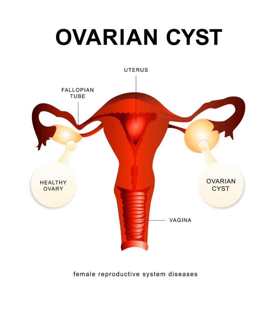 kaitan ovarian cyst dengan mitos kanser ovari 