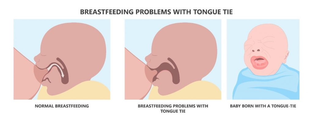 lidah pendek atau tongue tie