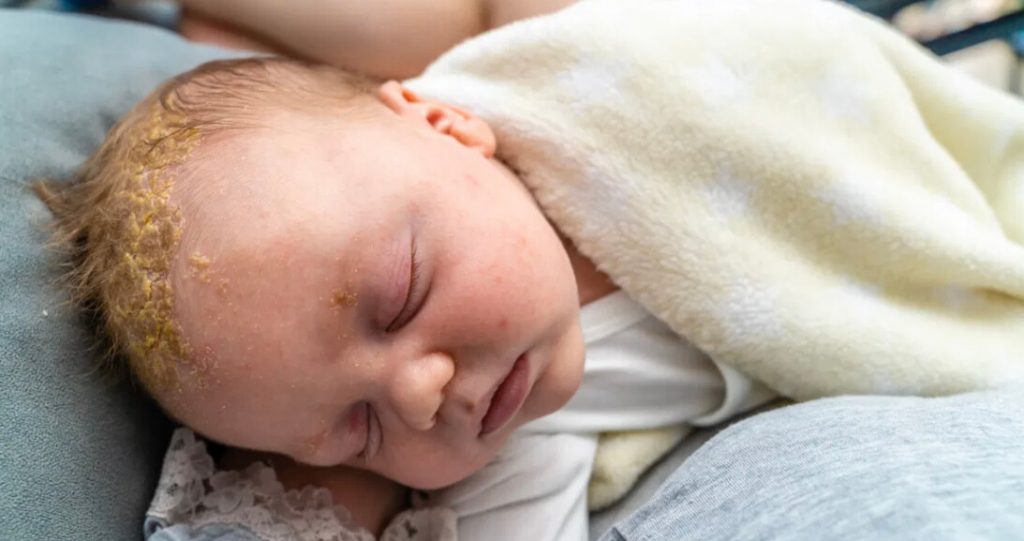 cradle cap merupakan antara perkara aneh tentang newborn