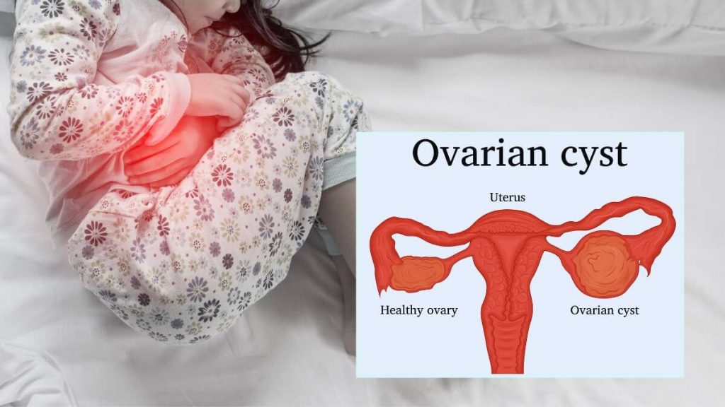 budak alami ketumbuhan dalam rahim atau ovaian cyst