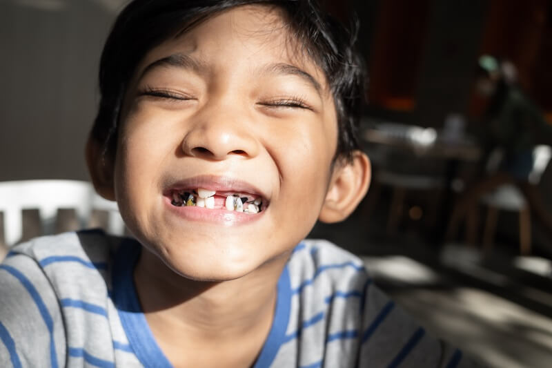 kanak-kanak dengan karang gigi dan gigi berlubang