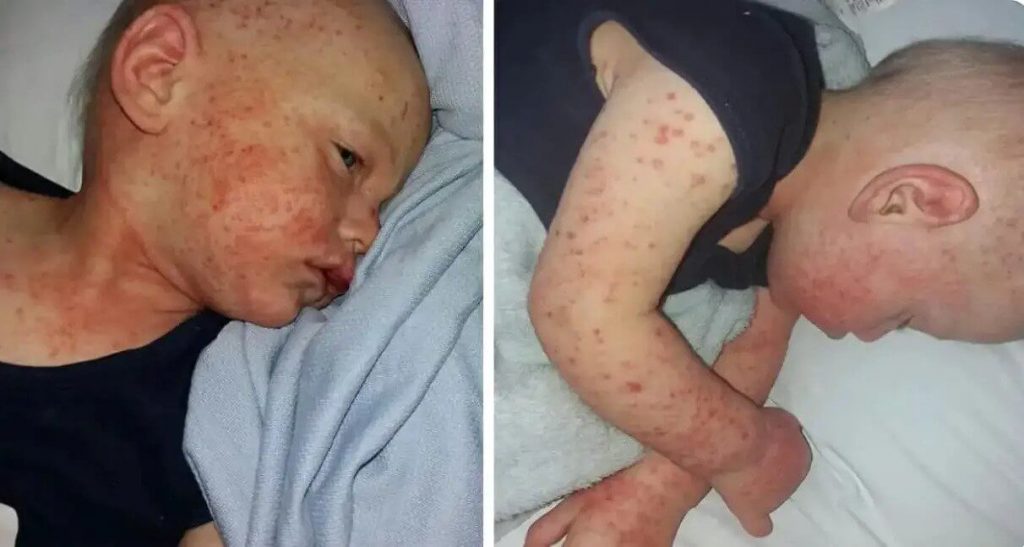 bayi yang dijangkiti ruam akibat penyakit herpes