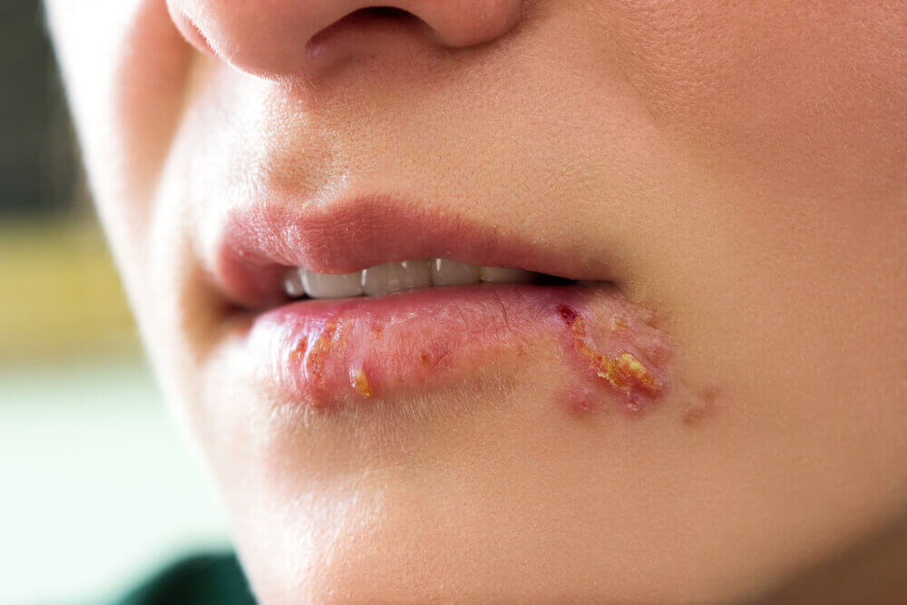 penyakit herpes oral