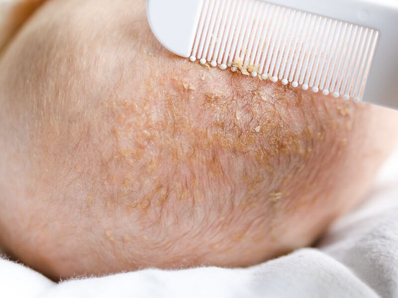 baby newborn - cradle cap