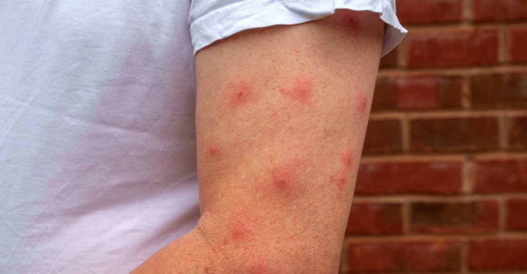 khasiat petai pada gigitan nyamuk