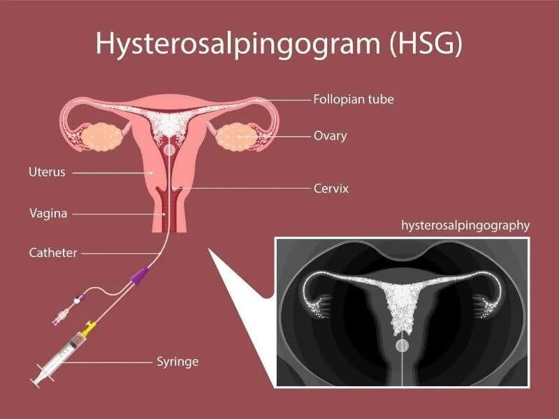 kesuburan wanita - hysterosalphingogram