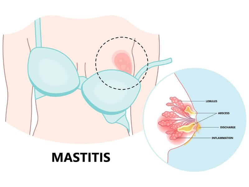 bengkak susu - mastitis 