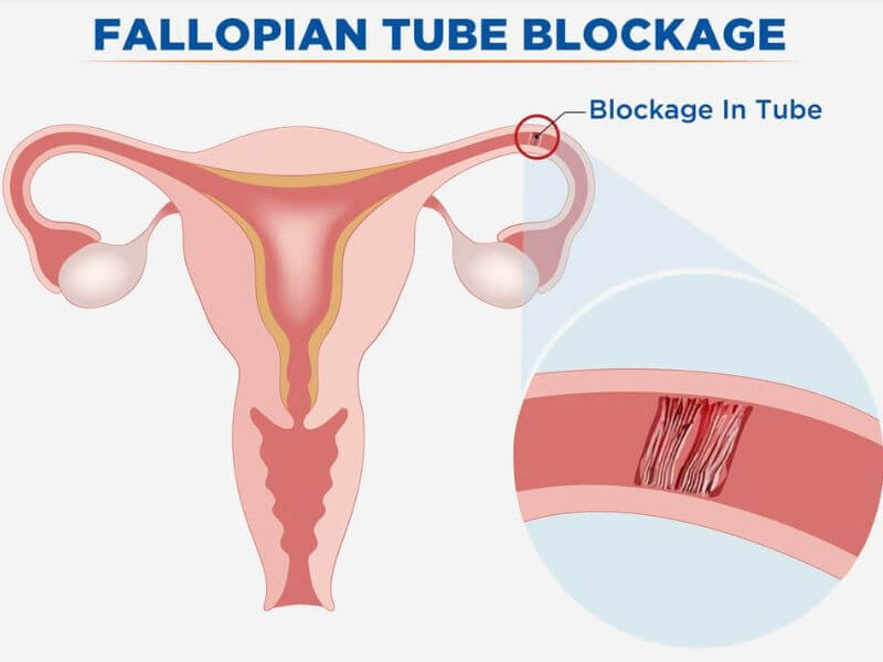 kesuburan wanita - tiub fallopio tersumbat