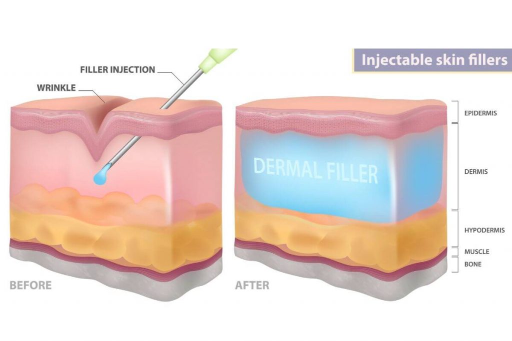 dermal fillers