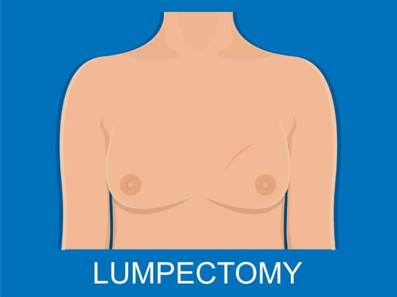 pinktober - umpektomi lumpectomy