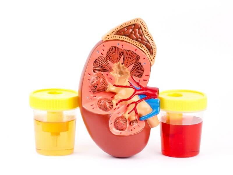 kanser pundi kencing - kencing darah atau hematuria