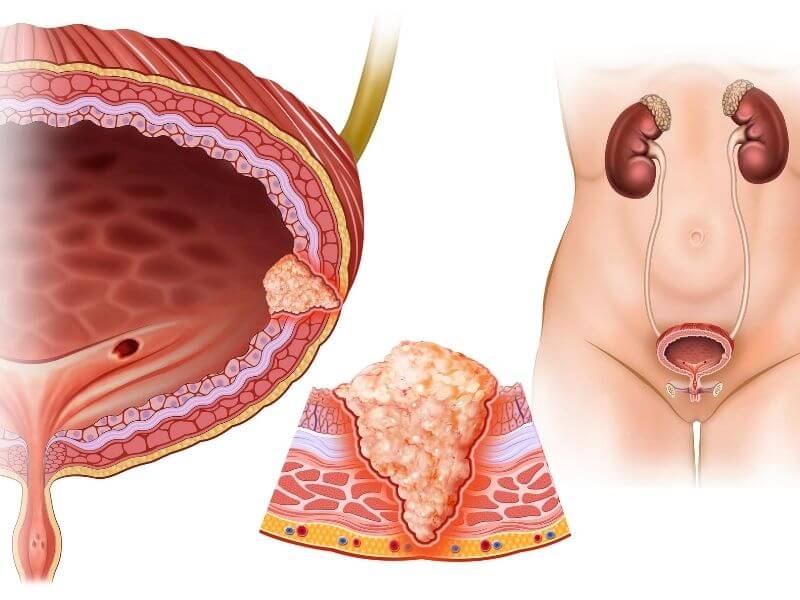 kanser pundi kencing - papillary kanser pundi kencing