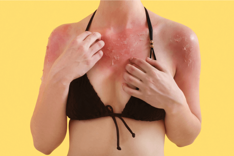 bahaya sinaran UV pada kulit hingga melepuh