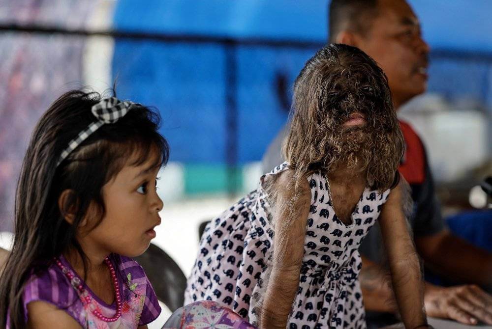 Missclyen anak Roland, kanak-kanak dengan penyakit Hypertrichosis