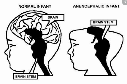 acrania