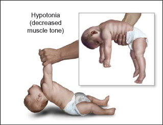 madu - bayi hypotonia