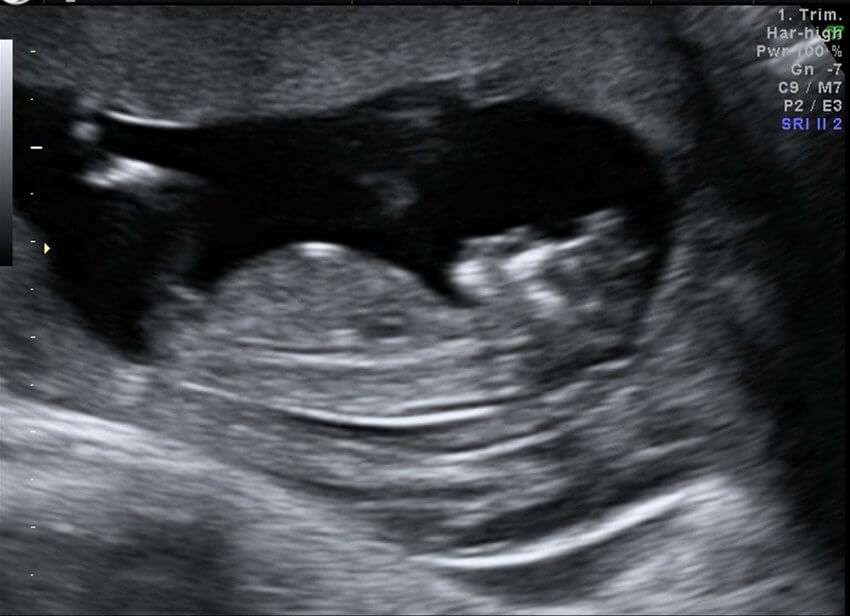 acrania - first trimester ultrasound bayi acrania