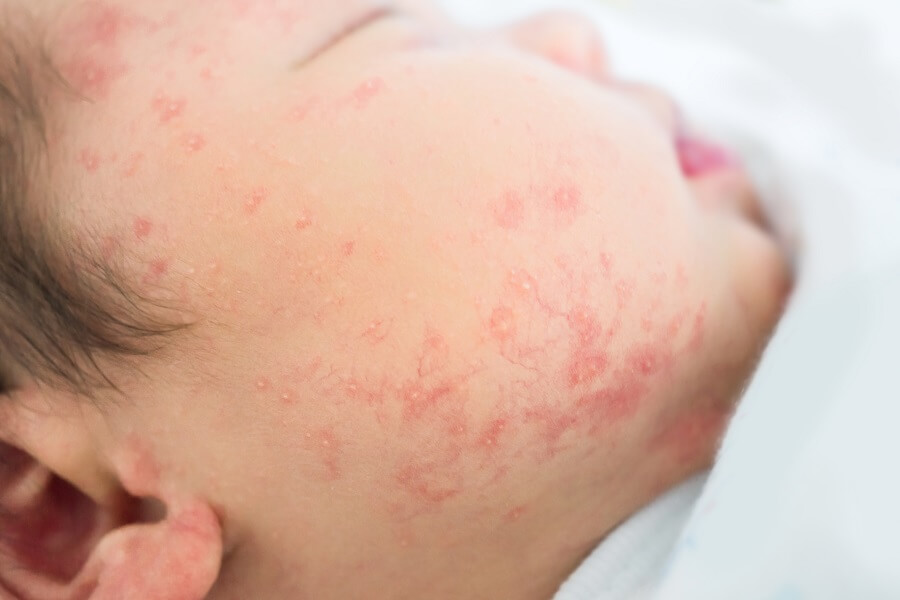 demam - bayi demam alergi