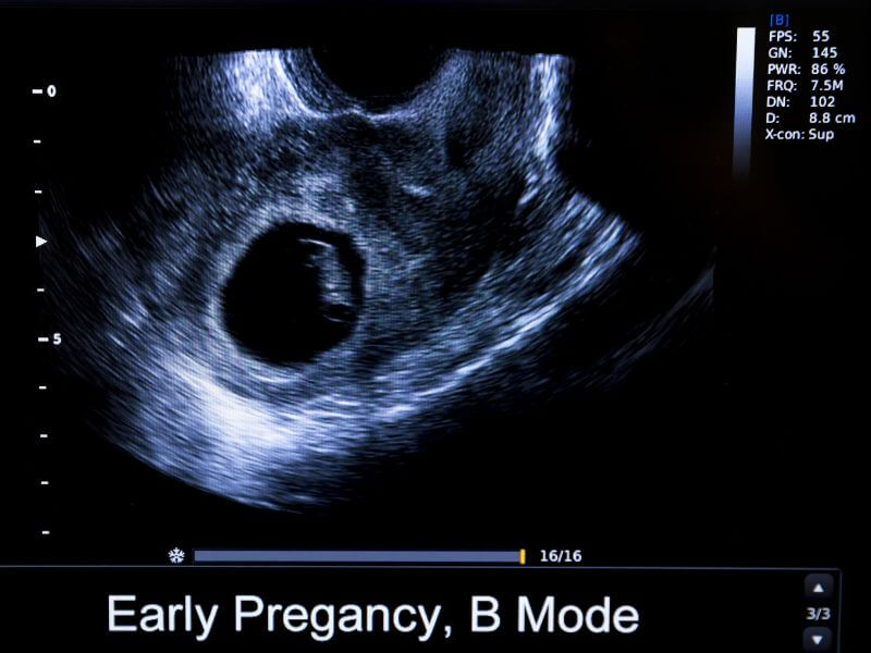 jenis scan - scan awal kehamilan