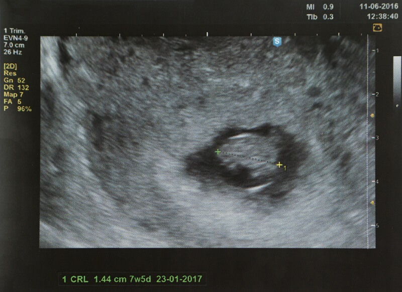 ultrasound scan kandungan 7 minggu