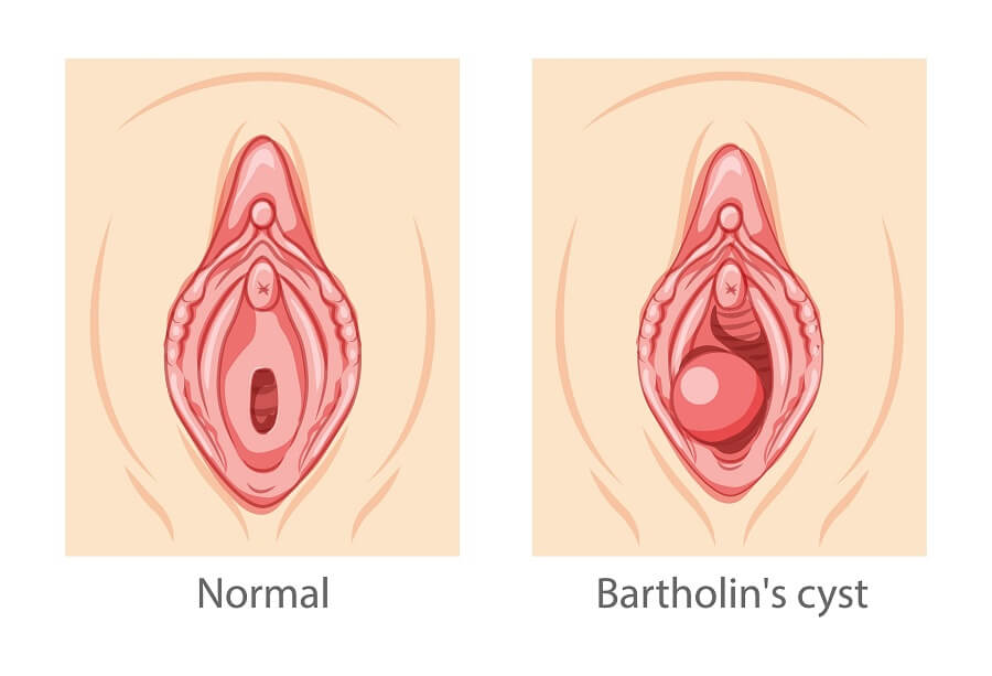 bartholin cyst