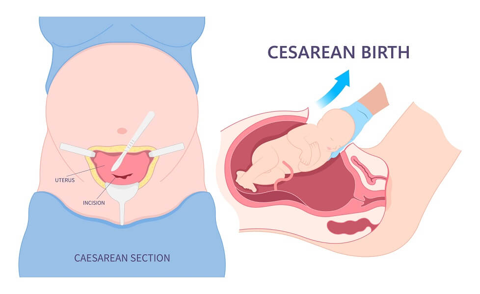 jenis bersalin