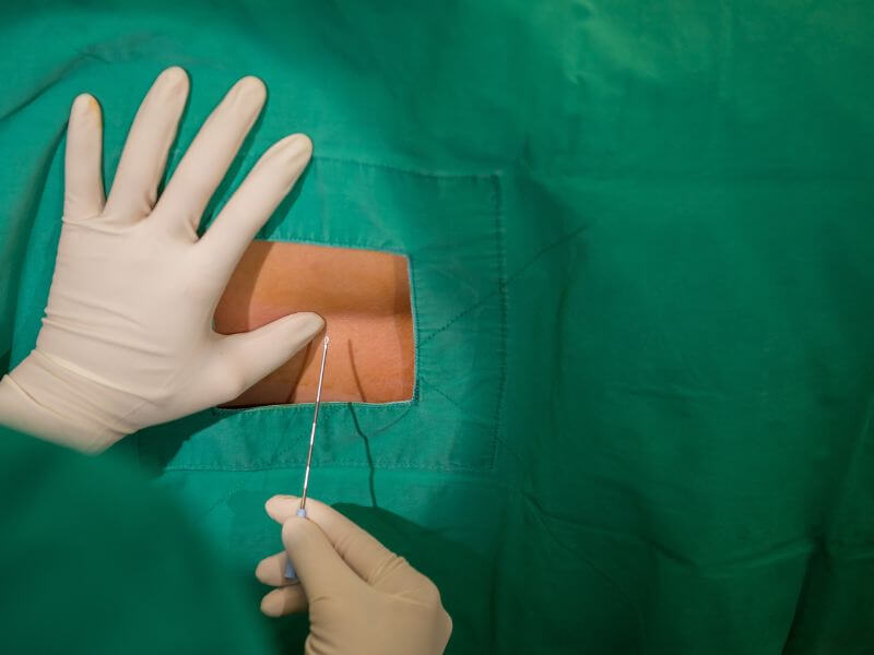 epidural