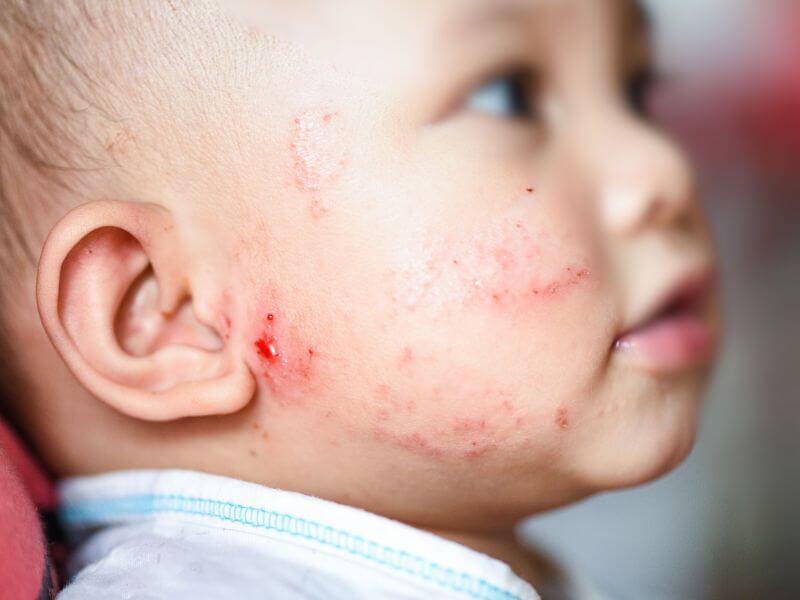 masalah kulit bayi