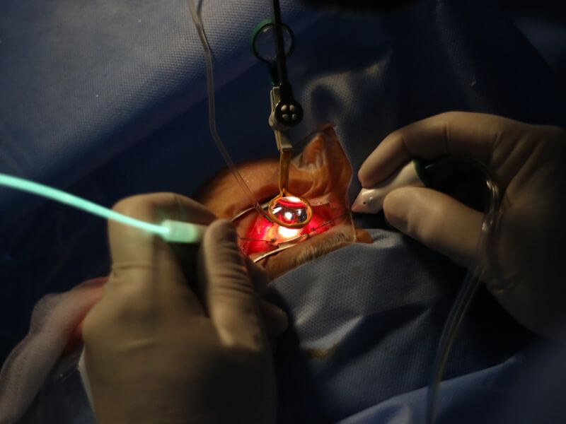 retina  - vitrektomi 